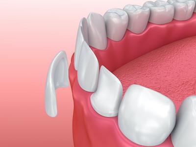 An illustration of a dental veneer being placed on a tooth
