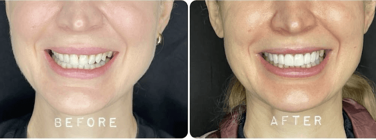 A before and after image of a patient who received dental veneers in Scottsdale