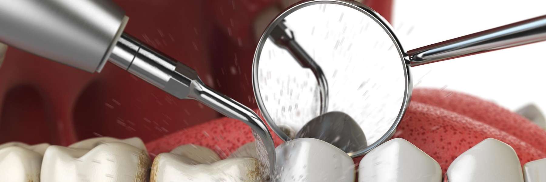 An illustration of a dental cleaning in Scottsdale, AZ