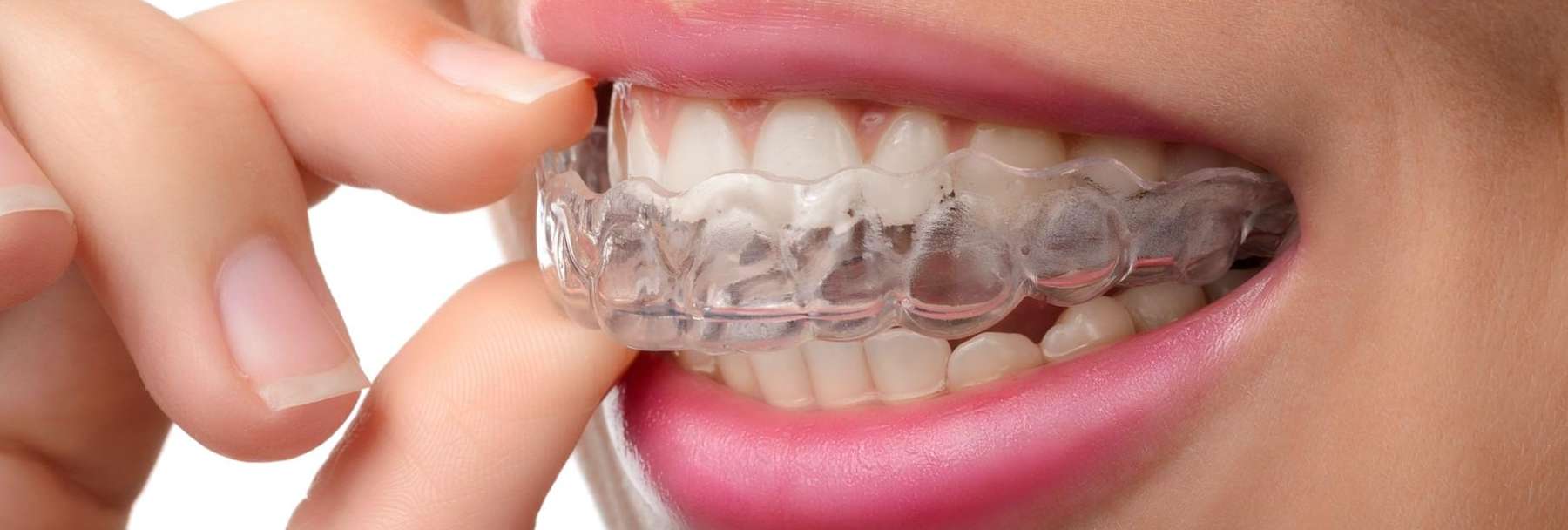 A woman putting in her Invisalign tray