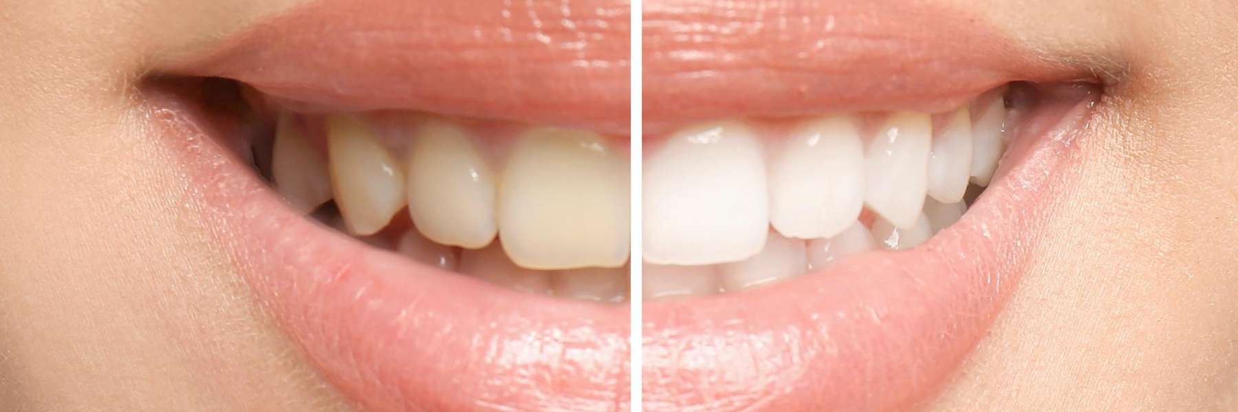 A before and after teeth whitening photo | cosmetic dentist scottsdale az