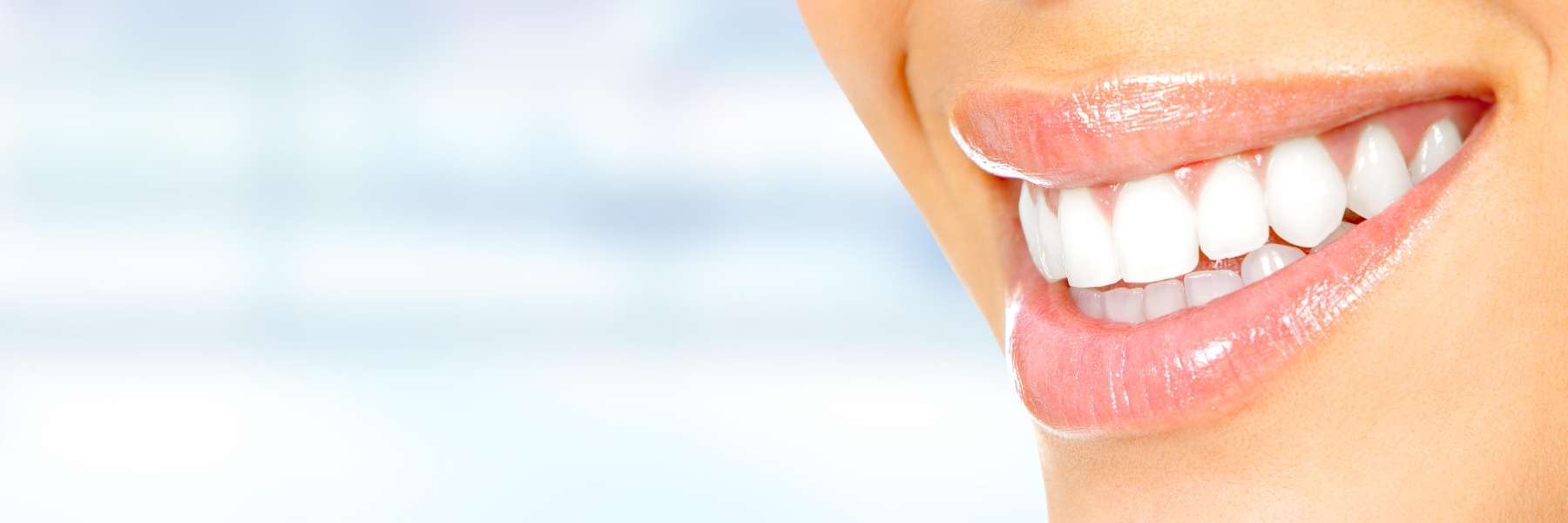 A woman with veneers smiling
