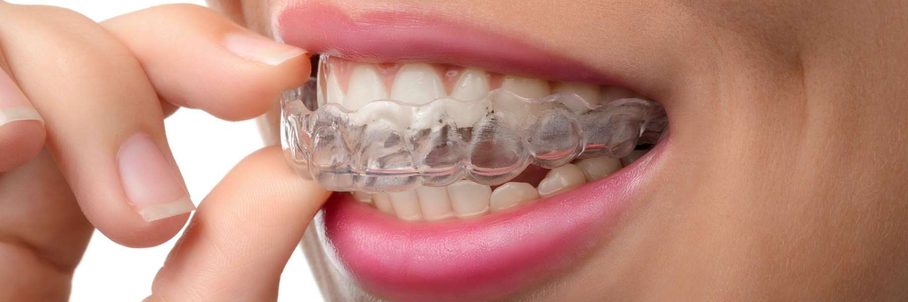 A smiling woman putting in her Invisalign tray