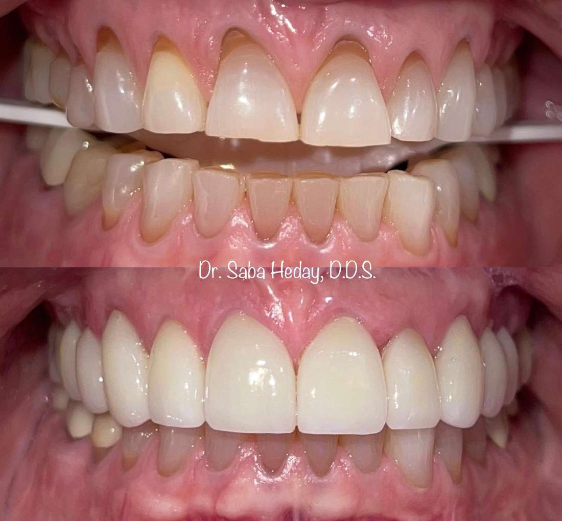 Veneers vs. Bonding Other Scottsdale AZ