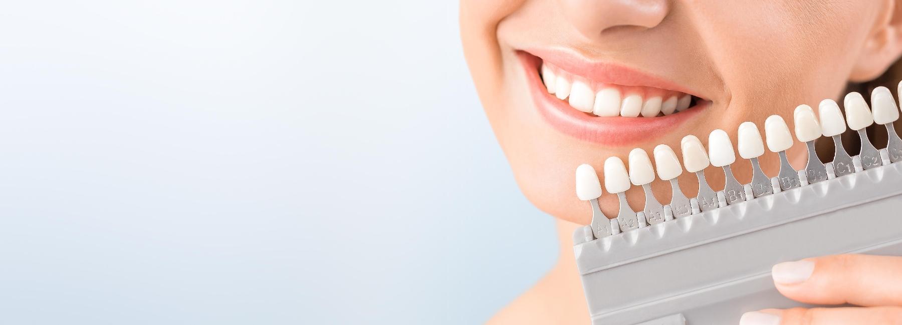 Veneers | Dentist