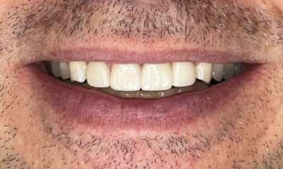 After treatment - Aesthetic Porcelain Bridge