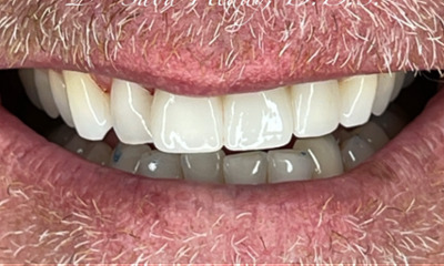 After treatment - Aesthetic Porcelain Ceramic Bridge
