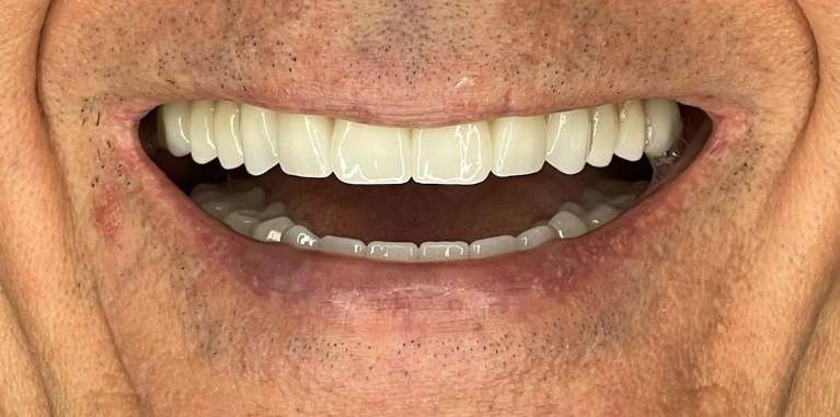 A smiling patient after receiving dental implants in Scottsdale, AZ