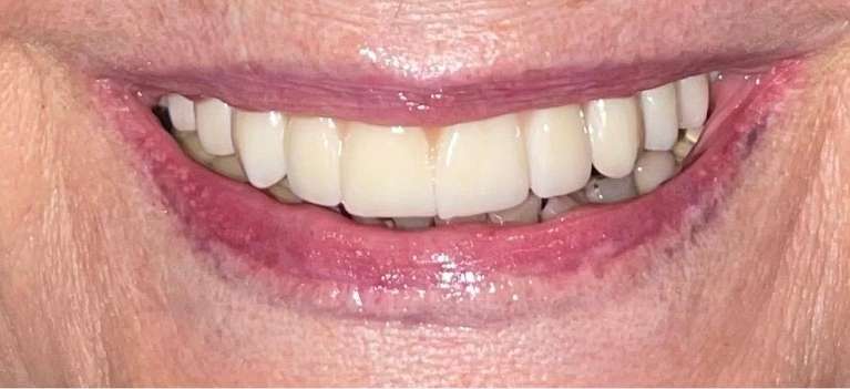 A patient's smile after receiving full porcelain zirconia prosthesis in Scottsdale, AZ