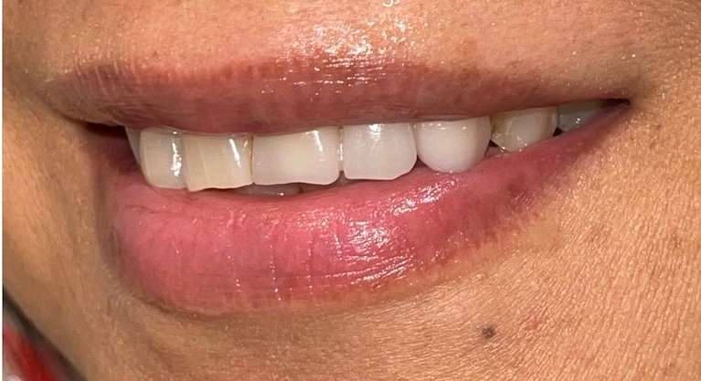 A patient after receiving new porcelain dental bridges in Scottsdale