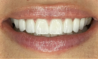 After treatment - No Prep Veneers