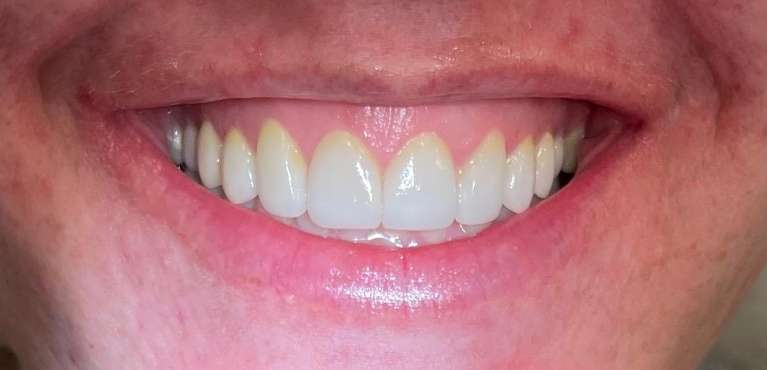 A female patient after getting a smile makeover in Scottsdale, AZ
