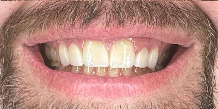 Patient teeth after getting veneers in Scottsdale, AZ