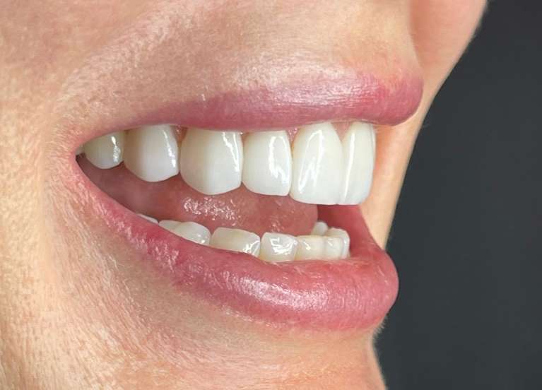 A female patient after receiving minimal prep veneers