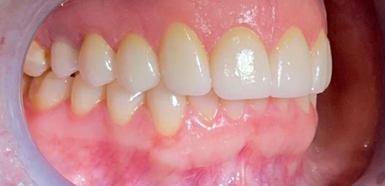 Close-up of patient teeth after getting a smile makeover in Scottsdale, AZ