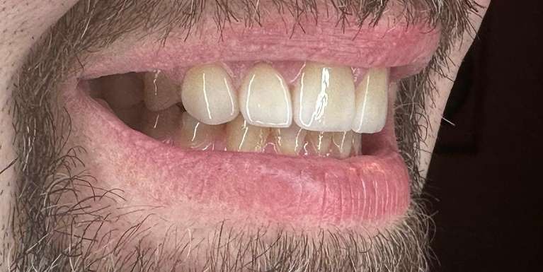 Patient teeth after getting veneers in Scottsdale