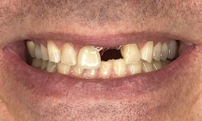 Before treatment - Aesthetic Porcelain Bridge