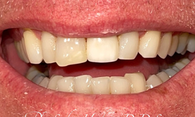 Before treatment - Aesthetic Porcelain Ceramic Bridge