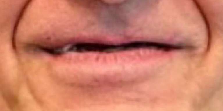 A patient with missing teeth before receiving dental implants
