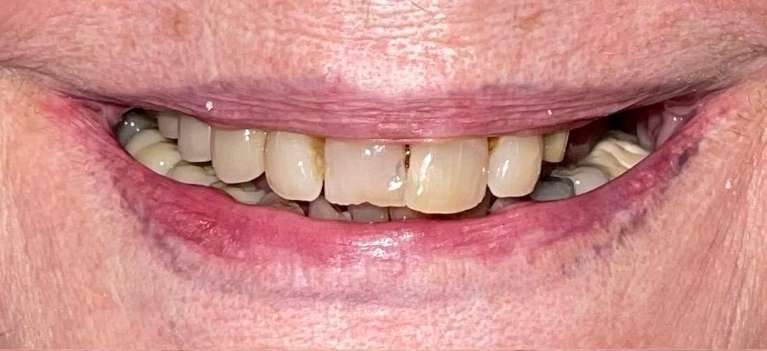 A patient with missing teeth