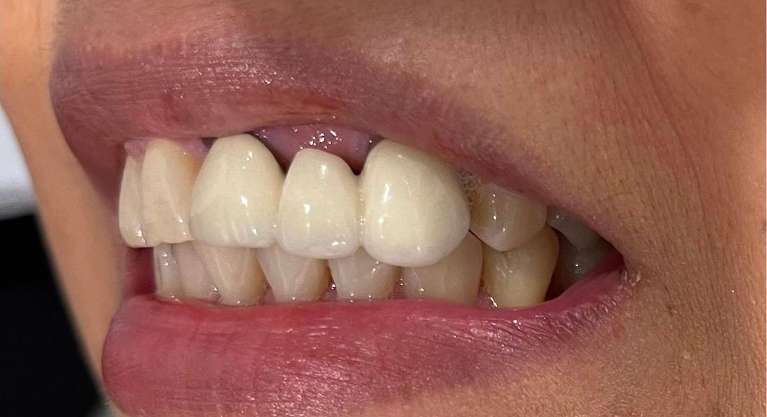 A patient with an old dental bridge