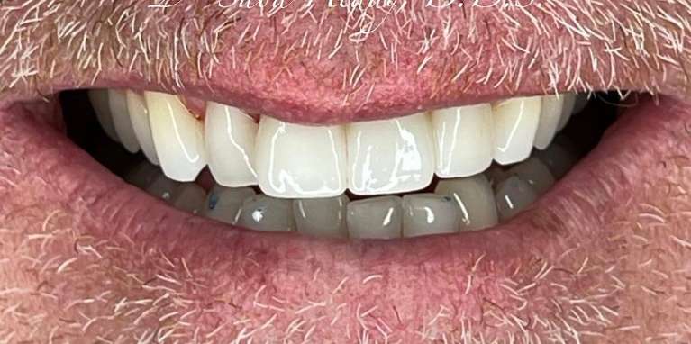 Aesthetic-Porcelain-Ceramic-Bridge-Before-Image