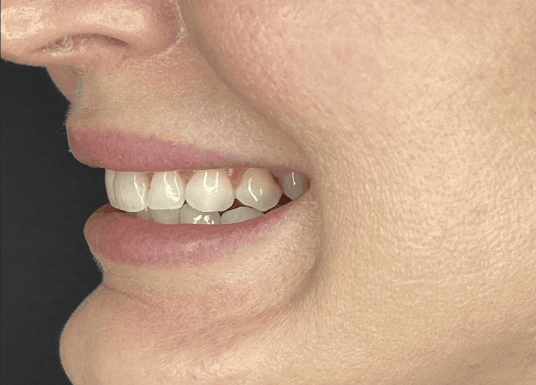 A woman before receiving no prep veneers