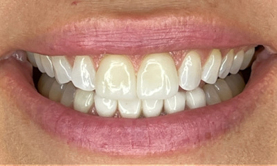Before treatment - No Prep Veneers