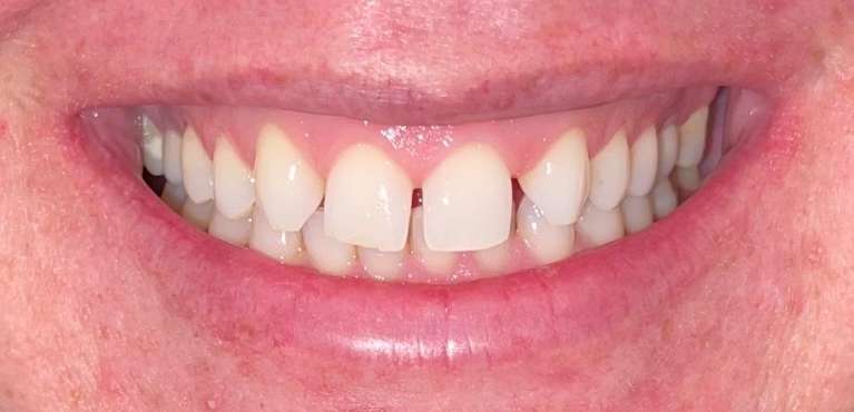 A female patient before getting a smile makeover Scottsdale, AZ