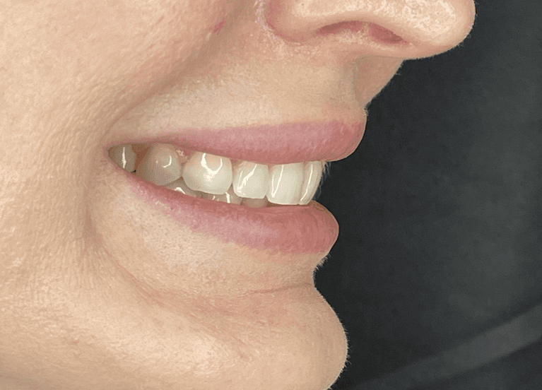 A female patient before receiving no prep veneers