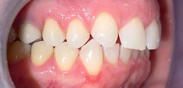 Close-up of patient teeth before getting a smile makeover in Scottsdale, AZ