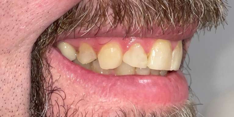 Patient teeth before getting veneers in Scottsdale